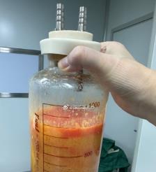 郑州水动力吸脂手术要做多久？